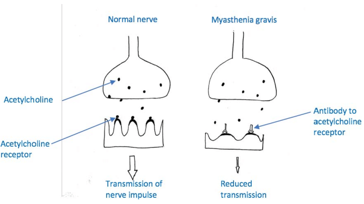 myasthenia gravis a látás előnyei és hátrányai